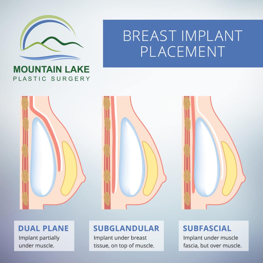 Understanding the Four Variables of Breast Augmentation - Bortnick